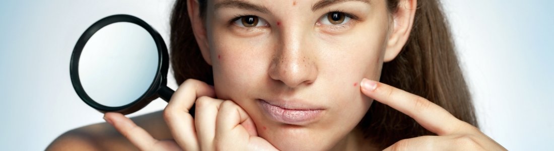 ACNE: SECONDA CAUSA DI DEPRESSIONE TRA GLI ADOLESCENTI